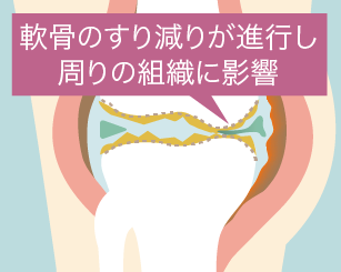 進行期のひざ関節